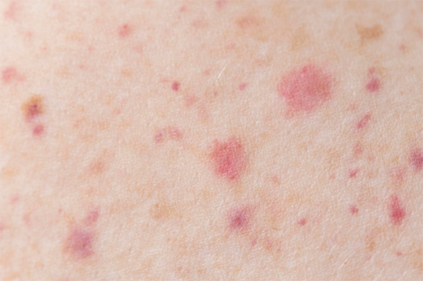 Skin Infections Caused by Floods: From Symptoms to Prevention