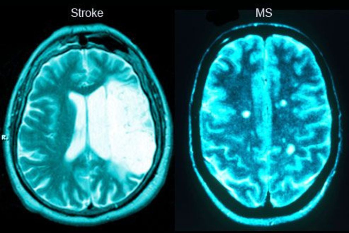Causes of Bell’s Palsy