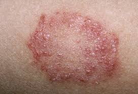 Skin Infections Caused by Floods: From Symptoms to Prevention