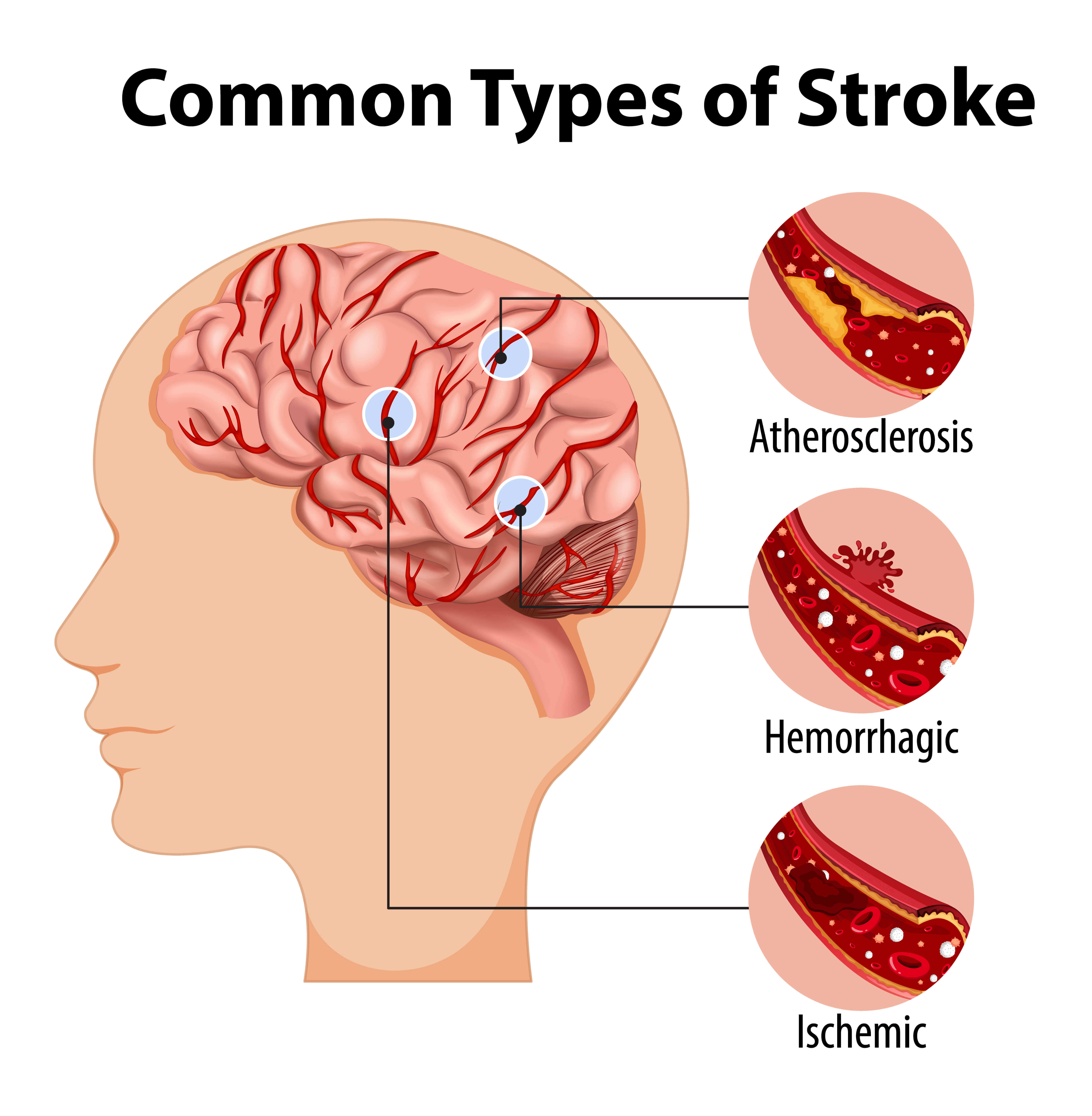 Stroke: Causes, Symptoms, and Early Prevention