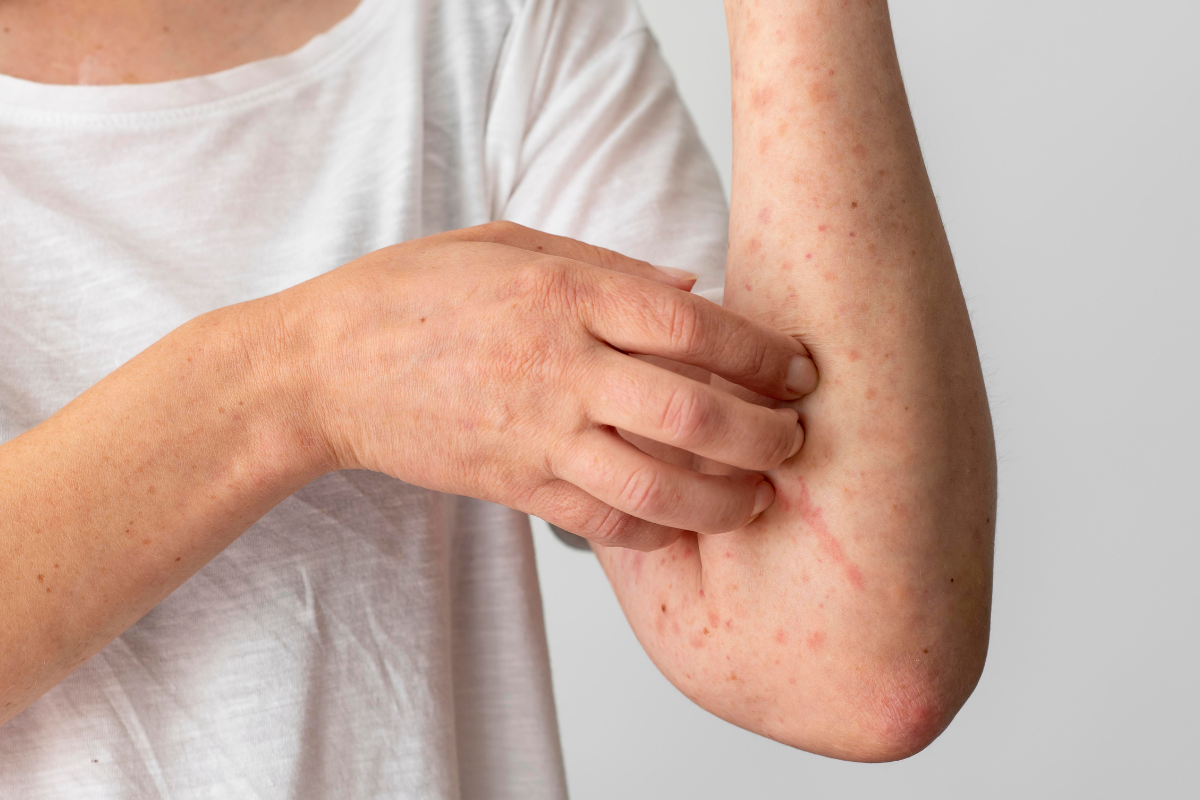 Measles Symptoms in Adults