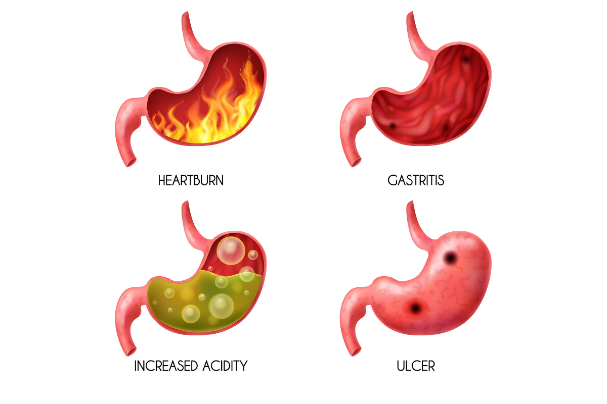 GERD atau Gastroesophageal Reflux Disease